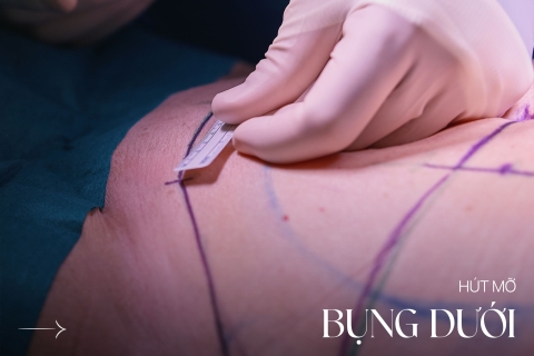 Hút mỡ bụng dưới